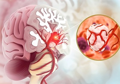 Best brain tumor treatment in Greater Noida